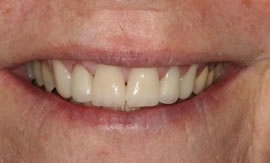 CEREC AC OMNICAM ПРОСТОЕ СКАНИРОВАНИЕ БЕЗ АНТИБЛИКОВОГО СПРЕЯ 21.jpg