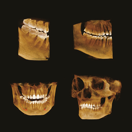 GENORAY Papaya 3D 23x14 - компьютерный томограф с цефалостатом 