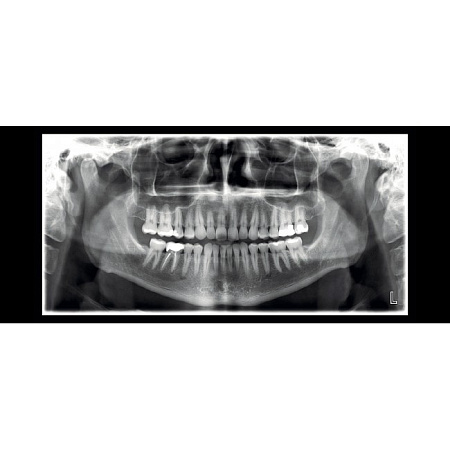 Planmeca ProMax 2D SCARA 3 - рентгеновская установка с цефалостатом