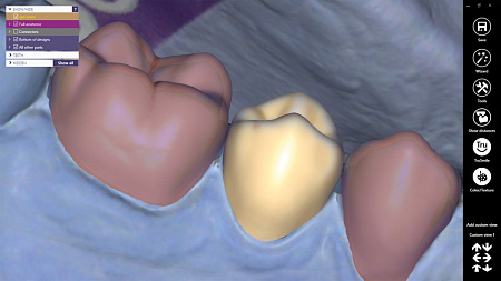 Exocad Provisional - модуль временных конструкций