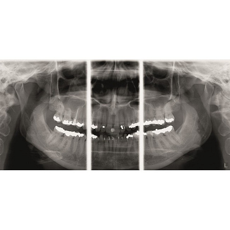 KaVo Pan eXam Plus Ceph - универсальный датчик Pan/Ceph для панорамной томографии, цефалостат, возможность дооснащения функцией 3D-томографии 6x8 см