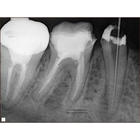 Genoray PORT-X II NEW - портативный высокочастотный интраоральный рентгеновский аппарат