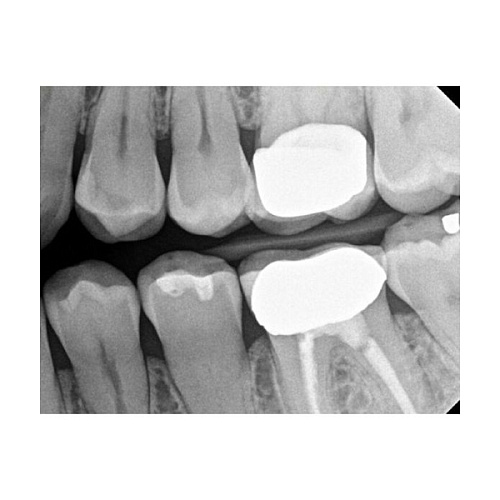 Carestream Kodak RVG 6200 - радиовизиограф