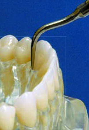 Acteon насадка №10P – Насадка наддесневая и поддесневая (<2-3 мм), улучшенная ирригация