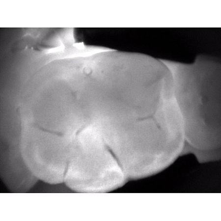KaVo DIAGNOcam - прибор для диагностики кариозных поражений